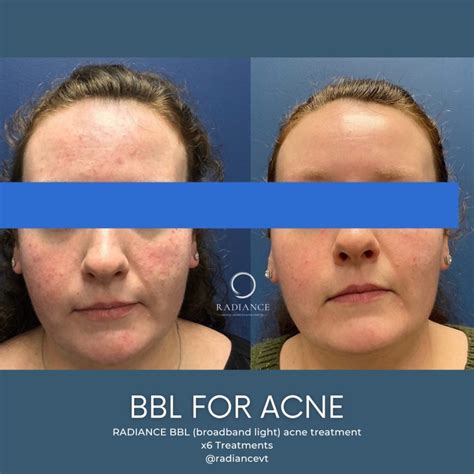 Everything You Need To Know About BBL Broadband Light Therapy For Acne | Radiance Medical ...