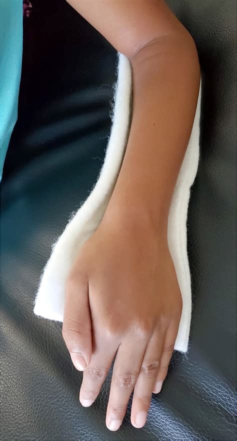 Common Fractures of the Radius and Ulna | AAFP