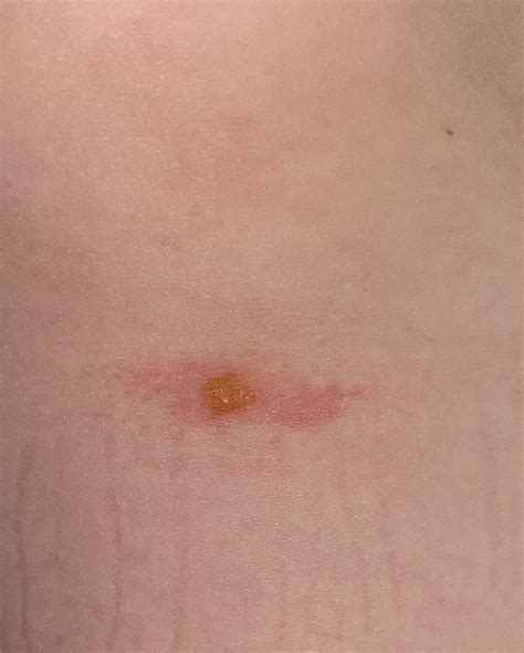 bite(?) from a stink bug : r/bugbites