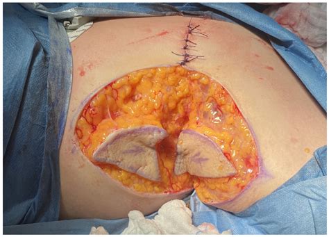 Surgical Treatment of Axillary Hidradenitis Suppurativa Using Preliminary Defect Closure and Two ...