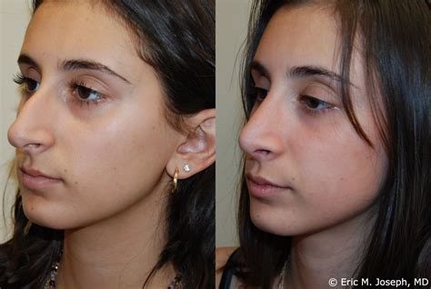 Eric M. Joseph, MD | Rhinoplasty Before & After: Septoplasty and Turbinate Reduction