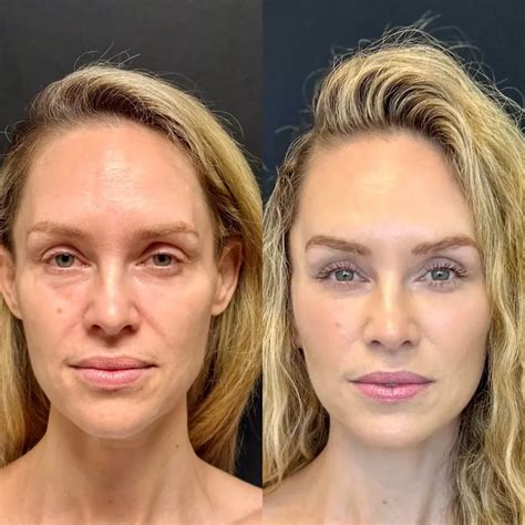 Brow Lift Before and After - Before After Journey