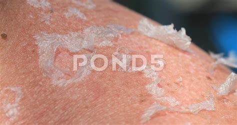 Sun Burn Face Peeling