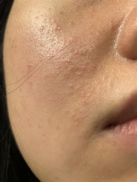 Whiteheads On Cheeks Acne Face Mapping: Know What Pimples On Your Face