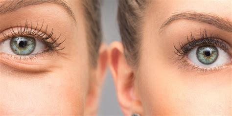 How Long Does Sculptra Last for the Face? — Vyla Aesthetics | Best Botox in Park City, Utah