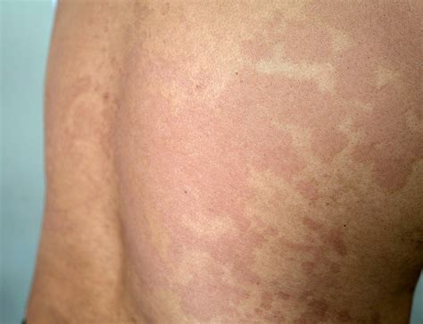 Tinea versicolor — Medical Secrets