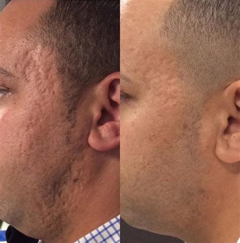 Microneedling Before and After Photo Gallery | Sacramento, CA | Destination Aesthetics