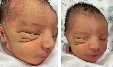 Neonatal diagnosis of circumferential skin creases - Cauzzo - 2023 - Birth Defects Research ...