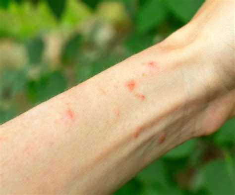 How To Identify Poison Ivy To Prevent A Painful Rash | Gardening Know How