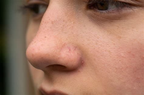 The connection between Demodex Mites and Rosacea | The Derm NP