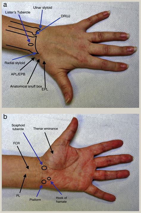 Ulnar Styloid Process Palpation I) Examination Of The Wrist—soft