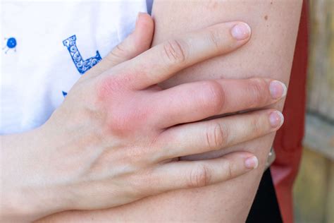 Sudden Pain & Swelling in Finger Joints: Causes, Treatment