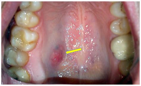 Mucoepidermoid Carcinoma Palate
