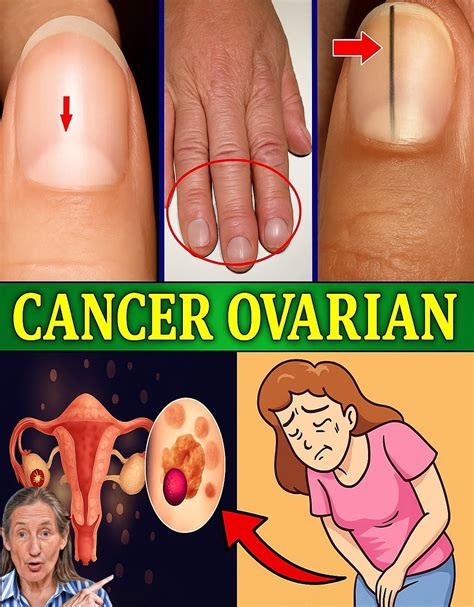 Ovarian Cancer: Recognizing the Signs and Symptoms…. – Home