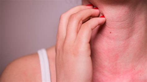 ¿Qué son las Alergias? | Sweet Adventures