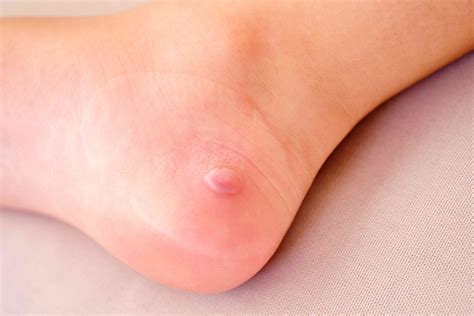 How to Stop Foot Blisters in Their Tracks