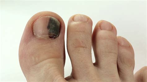Hematoma Under The Nail Emergency Medicine News