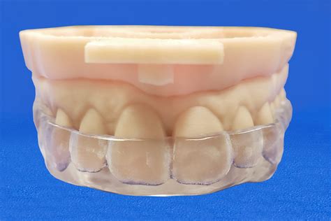 Bite Splints - Classic Craft Dental Lab