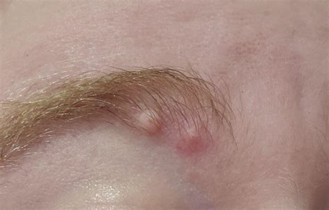 Sebaceous Cyst Eyebrow at Phoebe Reddall blog