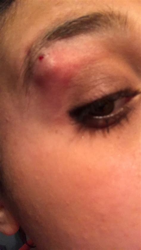 Eyebrow Piercing Infection