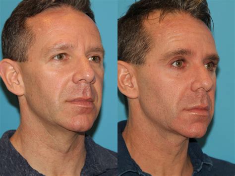 Sculptra® Before and After Photo Gallery | Atlanta, Georgia | Buckhead Facial Plastic Surgery