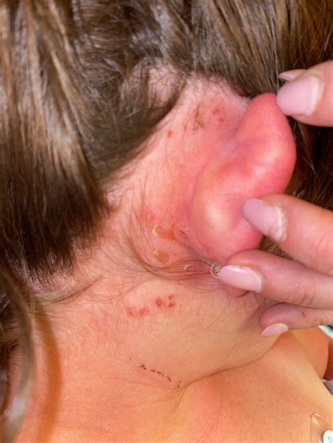 Staphylococcal Scalded Skin Syndrome