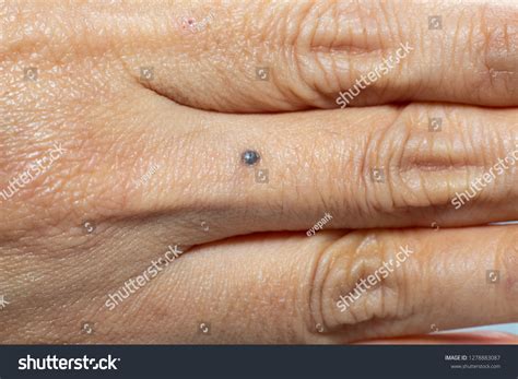 Black Mole On Womans Middle Finger Foto Stok 1278883087 | Shutterstock