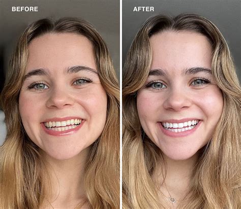 Top 5 Teeth Whitening Kits