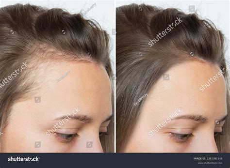 Hair Loss Before And After How A Revolutionary New Injection Grew Back