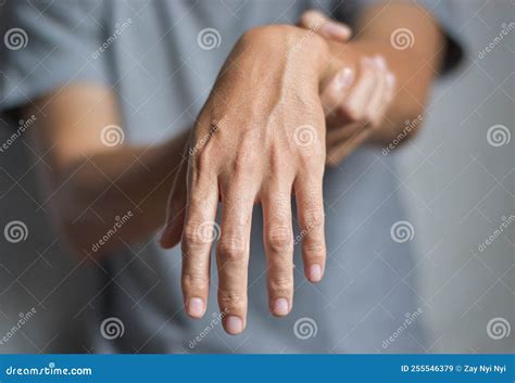 Radial Nerve Injury or Wrist Drop Stock Image - Image of problems, nerve: 255546379