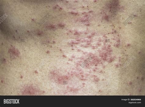 Itchy Stomach Rash Causes at Angela Bates blog