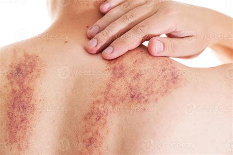 Redness and irritation on the skin of a man s back after a massage ...