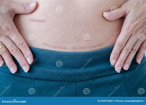 Appendix Scar Removal Before And After at James Engel blog