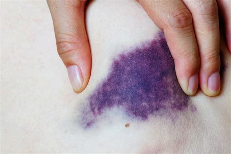 What To Use On Black And Blue Bruises at Larry Hinojosa blog