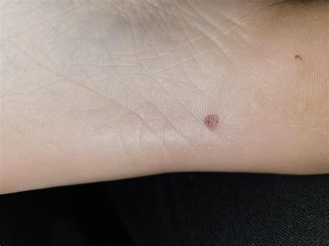 acral lentiginous melanoma on sole of foot? : r/Melanoma