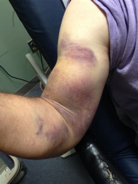 Biceps Tendon Rupture - JETem