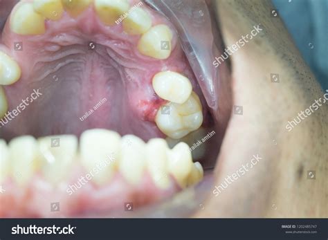 Gingival Swelling On Palate Periodontal Disease Stock Photo 1202485747 ...