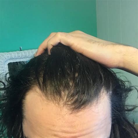 Receding Hair Line