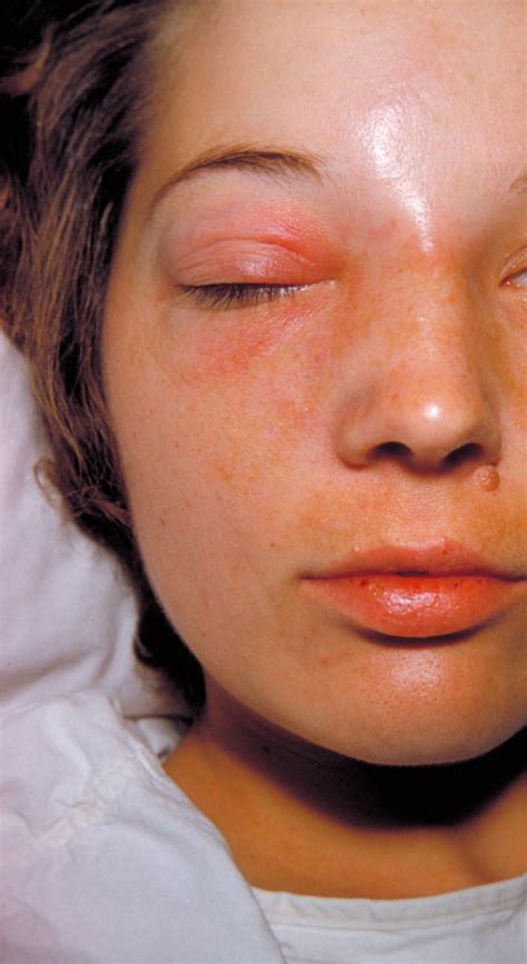 Orbital cellulitis - DocCheck