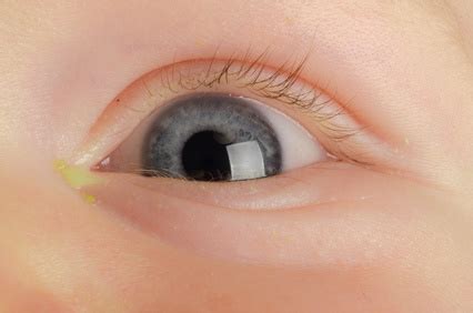 Newborn Eye Discharge: Causes and Treatments - New Kids Center