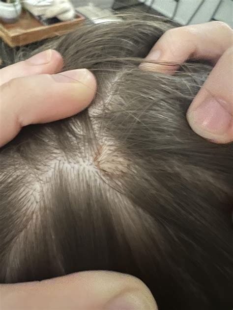 2 moles? On scalp : r/Melanoma