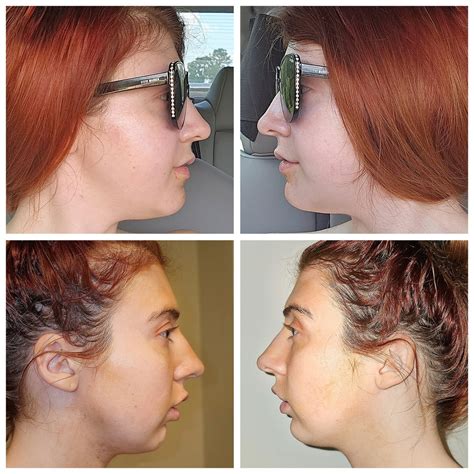 Before and After X-Rays (Double Jaw Surgery + Genioplasty) : r/jawsurgery