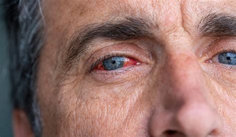 Hemorragia Subconjuntival Bilbao · Vizcaya | Instituto Oftalmológico ...