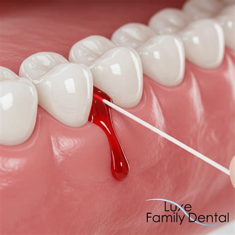 Dentist For Bleeding Gums