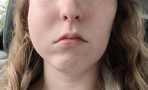 Why Cheek Swelling After Dental Injection Happens