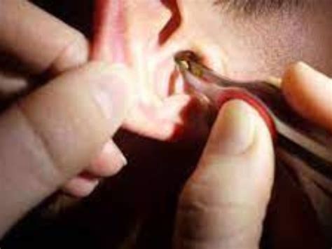Ear Wax Removal near me - Happy Ears Ear Wax Removal Clinics