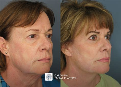 Lower Face & Neck Lift, Platysmaplasty, Quad Blepharoplasty, Fat Grafting, and CO2 Laser ...