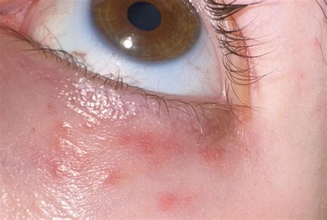 Advice on how to get rid of under eye redness/irritation : r/SkincareAddicts