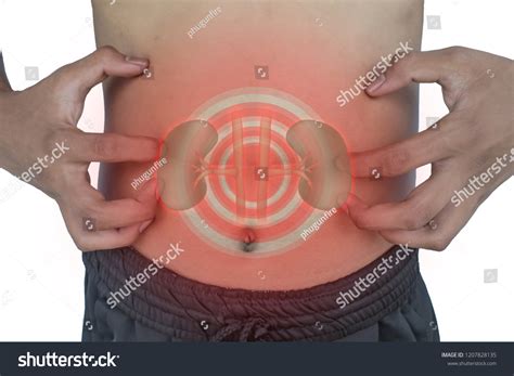 Scars Kidneys Diagnosis Kidney Disease Surgery Stock Photo (Edit Now ...
