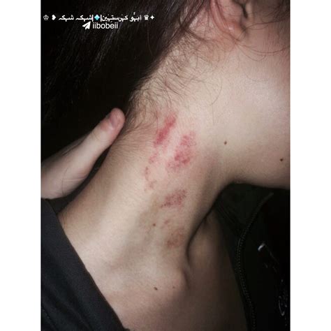 Hickies On Girls